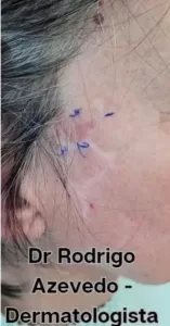 Foto de um carcinoma basocelular recidivado.