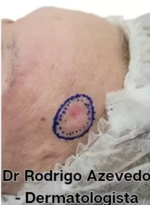 Foto de um carcinoma basocelular na testa de um paciente.