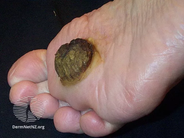 Foto de um carcinoma espinocelular localizado no pé