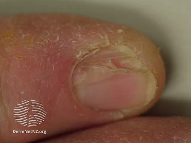 Foto de um carcinoma espinocelular localizado na unha da mão.