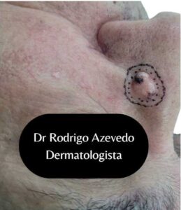 Carcinoma basocelular no nariz