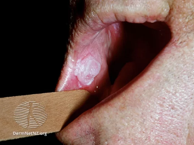 Foto de um carcinoma espinocelular localizado na mucosa da boca