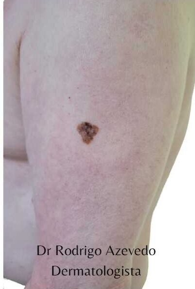 Melanoma no braço de um paciente.