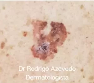 Foto de um melanoma no dorso de um paciente.
