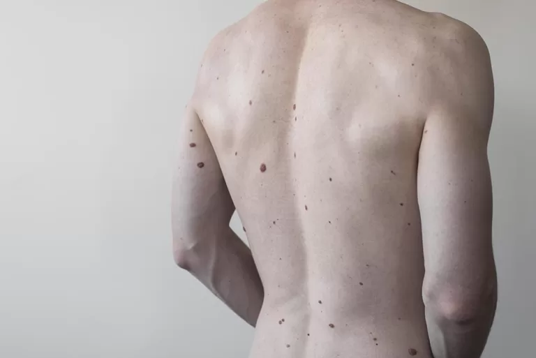 Homem com várias pintas nevos no dorso.