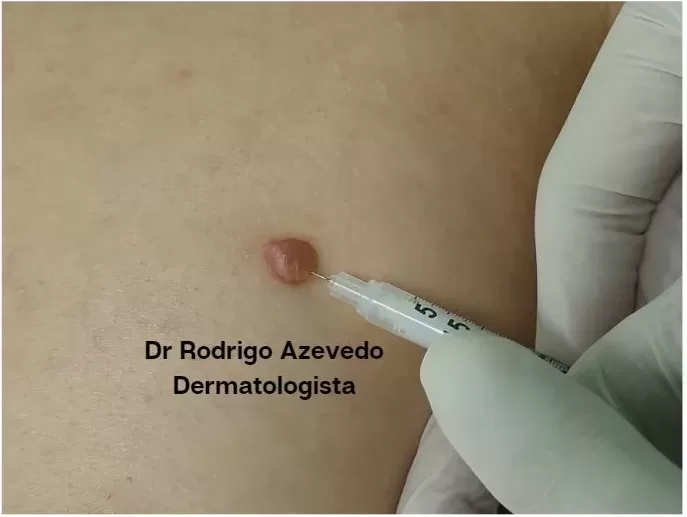 Foto do procedimento de infiltração de corticoide em uma cicatriz hipertrófica.